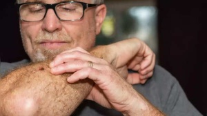Skin Cancer Alert: How to Recognize Suspicious Moles and Early Warning Signs