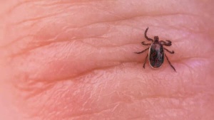 Tick Bite Paralyzes Fitness Enthusiast: A Cautionary Tale About Outdoor Risks and Lesser-Known Diseases