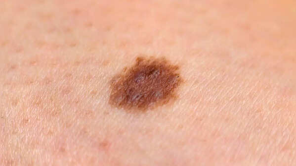 Pigment spreading from a mole can be an alarming sign.