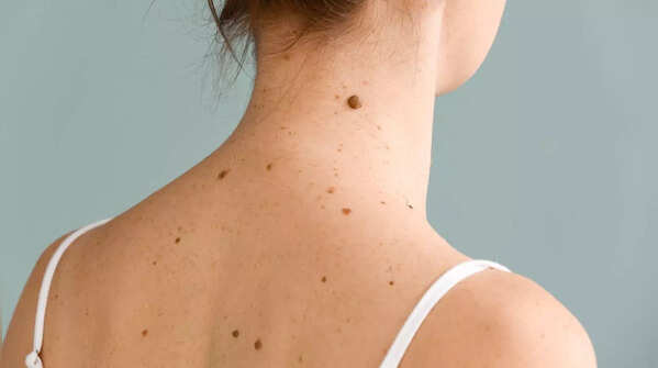 Be aware of any new growths on your skin.