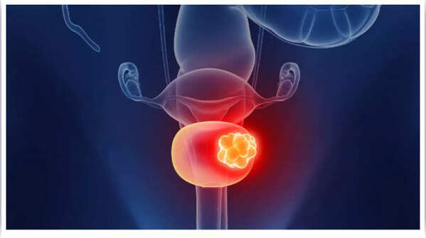 Lower back or pelvic pain can be a sign of advanced bladder cancer